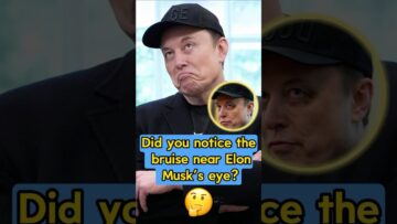 Did you notice the bruise near Elon Musk’s eye? The last reason behind it will blow your mind.#USA